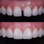Revitalising Your Smile with Composite Bonding Innovations
